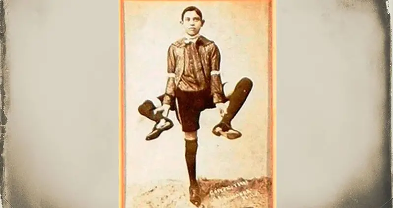 Meet Frank Lentini, The Sideshow Performer With Three Legs, 16 Fingers, And Two Penises