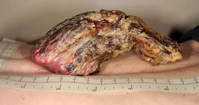 Doctors Remove 5-Inch-Long ‘Dragon Horn’ That Had Grown Out Of Man’s Back For 3 Years