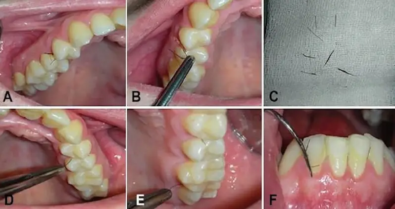 Woman Grows Hair In Her Mouth In Rare Case Of Gingival Hirsutism