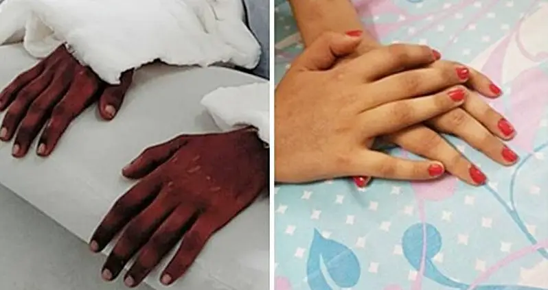 Patient’s Hand Transplants Unexpectedly Change Skin Tone To Match Hers