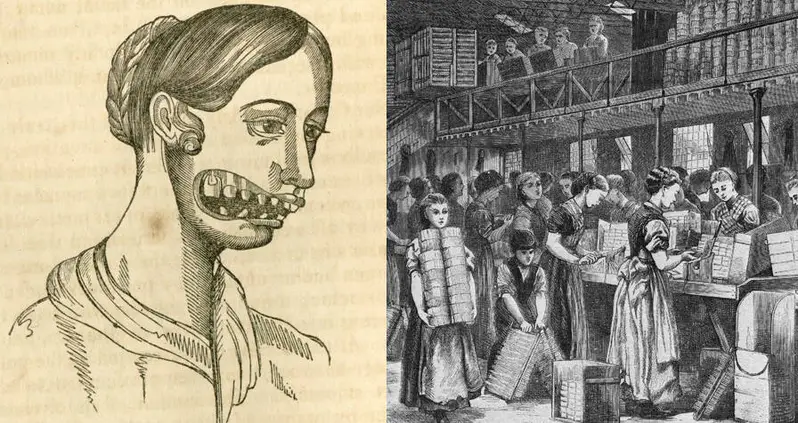 Inside ‘Phossy Jaw,’ The Deadly Condition That Plagued 19th-Century Matchstick Girls