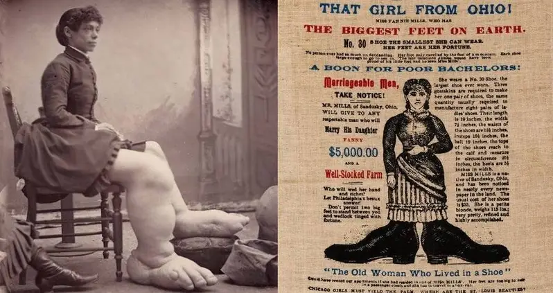 The Tragic Life Of Fanny Mills, The Legendary ‘Ohio Big Foot Girl’