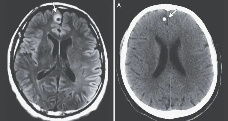 A Boston Man Started Having Mysterious Seizures — Then Doctors Discovered A Decades-Old Tapeworm In His Brain