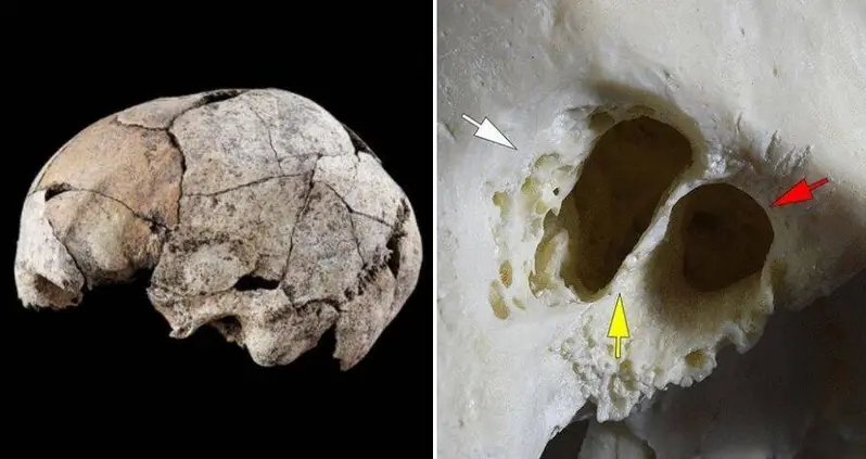 5,300-Year-Old Skull Unearthed In Spanish Tomb Shows Evidence Of Earliest Ear Surgery