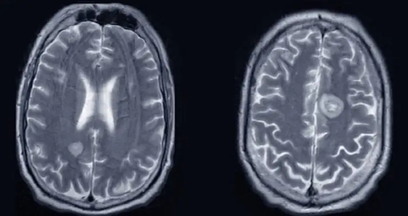 An American Man With Prostate Cancer Started Speaking In An Irish Accent In The Third Known Case Of Cancer-Related Foreign Accent Syndrome