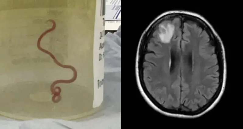 A Live Worm Was Removed From Australian Woman’s Brain In World-First Discovery