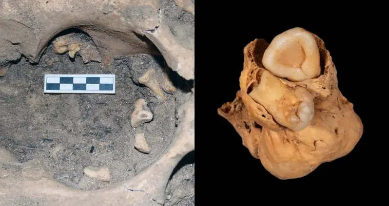 A Rare Ovarian Tumor With Teeth Was Found In The Body Of An Egyptian Woman Buried Three Millennia Ago