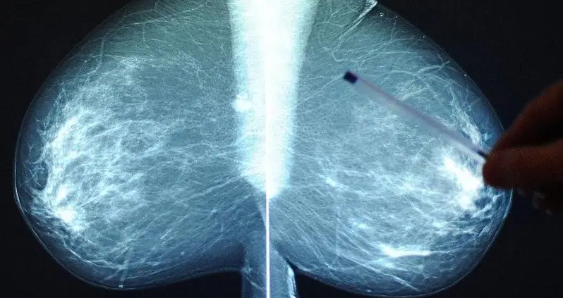 Four People Diagnosed With Breast Cancer After They Received Transplants From The Same Organ Donor
