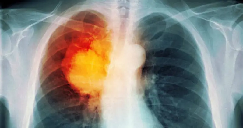 Israeli Scientists Claim ‘Complete Cure For Cancer’ One Year Away