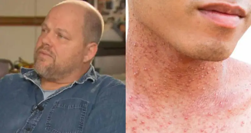 Vancouver Dad Who Caused Measles Outbreak Didn’t Vaccinate Kids Due To Autism Concerns