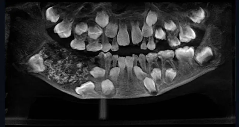 Indian Doctors Find 526 Teeth In Boy’s Mouth After Complaints Of Jaw Pain