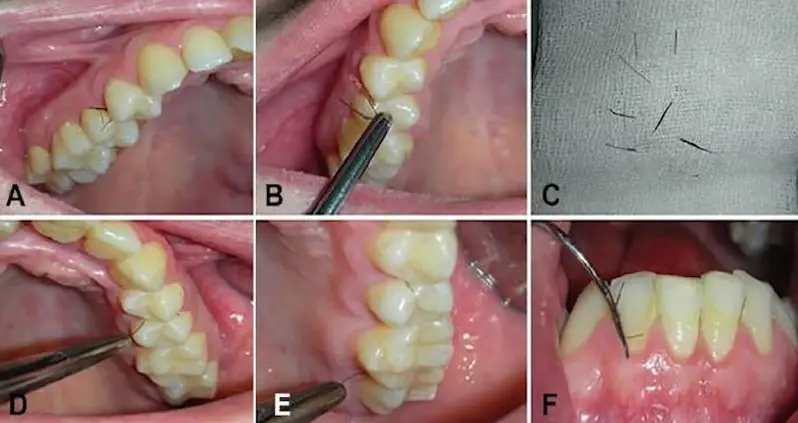 Woman Grows Hair In Her Mouth In Rare Case Of Gingival Hirsutism