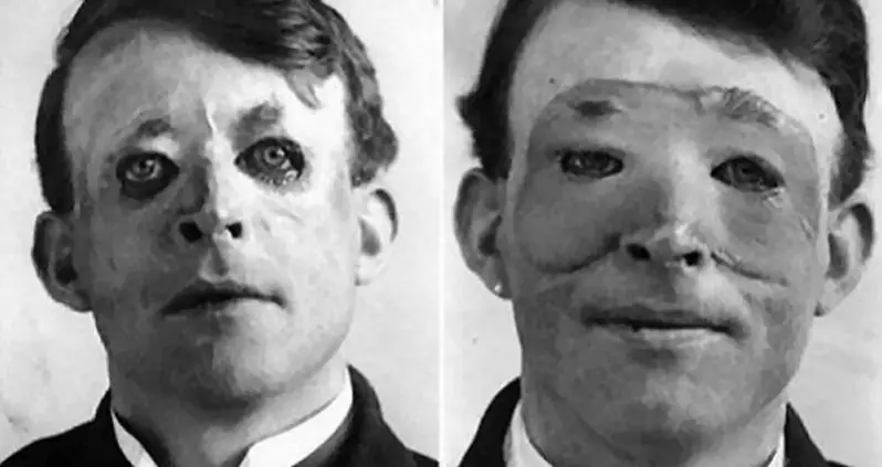Walter Yeo And When Plastic Surgery Was Worse Than The Injury