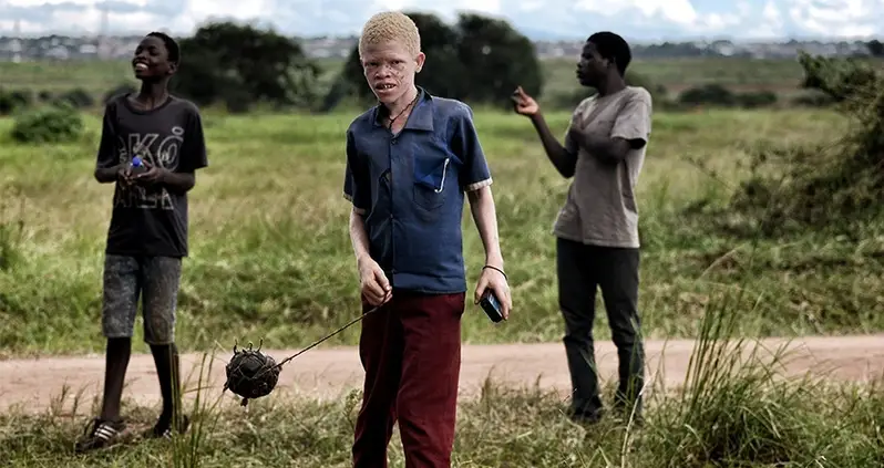 Albinos Are Being Hunted And Killed For Their Body Parts In Malawi