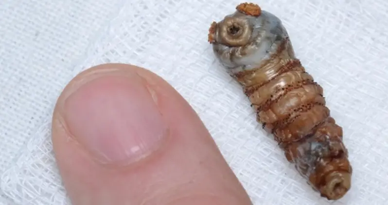 The Grossest Parasites That Can Actually Infect The Human Body