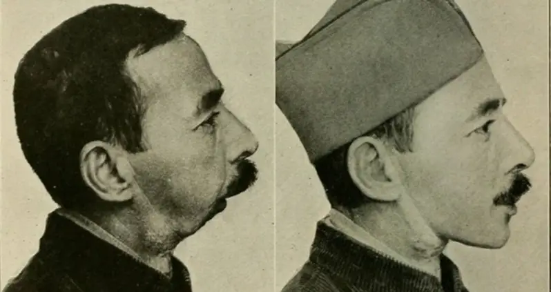 Before-And-After Photos Of Plastic Surgery’s Early Days