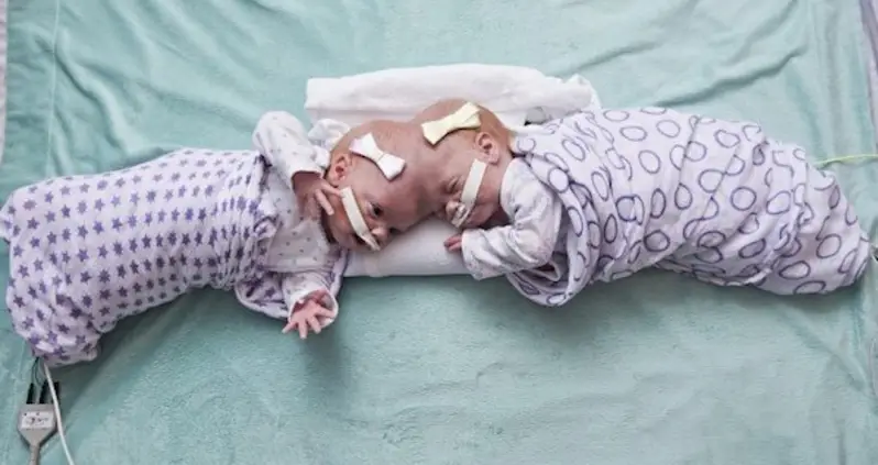 Baby Twins Conjoined At The Head Survive One Of The World’s Most Difficult Surgeries