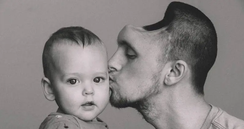 California Dad Loses Part Of His Skull After Drinking Too Many Energy Drinks