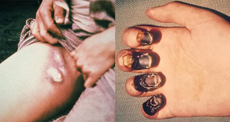 Black Death Symptoms: See If You Have The Bubonic Plague Right Now