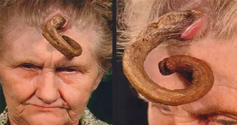 Cutaneous Horn — The Skin Growth That Turns Humans Into Unicorns