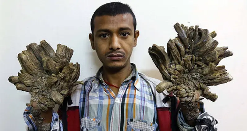 “Tree Man” Syndrome Turns People Into Living, Breathing Pieces Of Bark