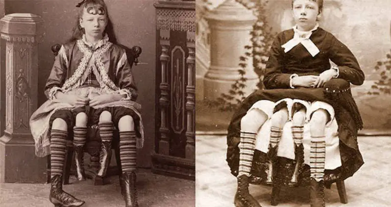 The Story Of Myrtle Corbin, P.T. Barnum’s “Four-Legged Girl From Texas”