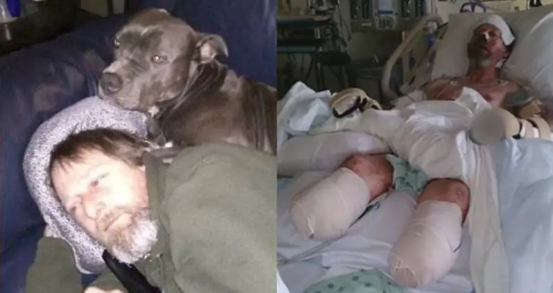 He Was Licked By A Dog, Now His Legs And Hands Have Been Amputated