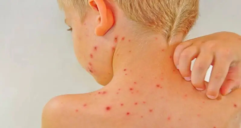 11-Month-Old Baby Suffers From A Stroke After Contracting Chickenpox