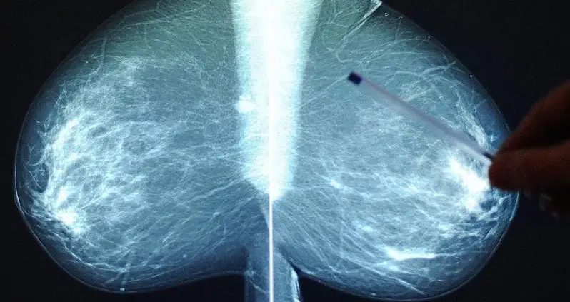 Four People Diagnosed With Breast Cancer After They Received Transplants From The Same Organ Donor