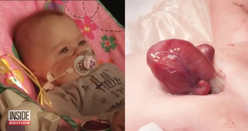 A Baby Born With Her Heart Outside Her Chest Will Go Home After 9 Months In The Hospital