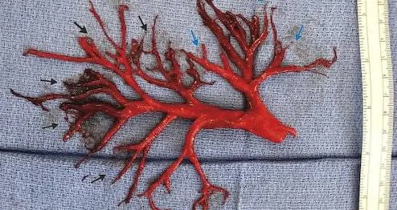 A Man Coughed Up A Blood Clot Shaped Exactly Like A Passage In His Lung