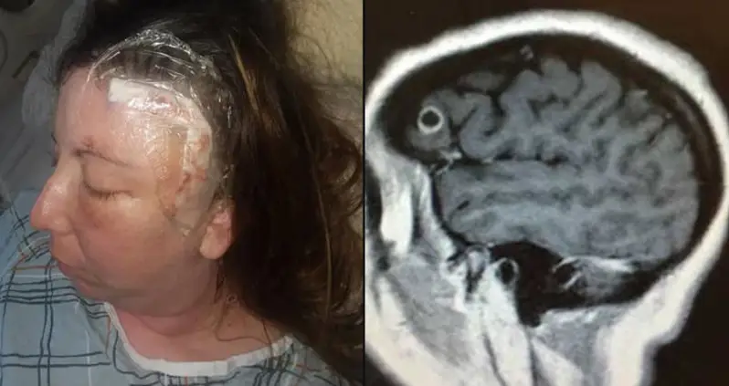 Woman Lived Nearly A Year With A Baby Tapeworm Suckling On Her Brain Thinking It Was A Tumor