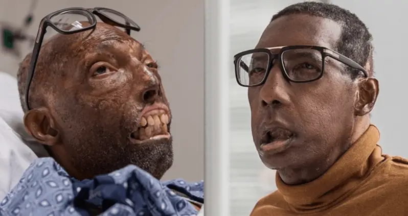 The First African American Man To Receive A Full Face Transplant Is ‘Thrilled’ With The Results