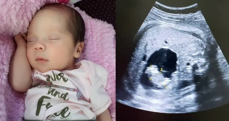 A Baby Was Born ‘Pregnant’ With Her Own Twin And Needed A C-Section To Remove It
