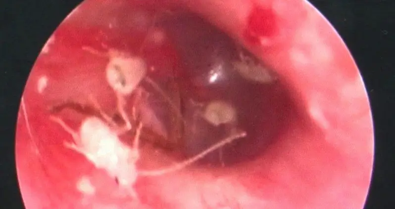 Family Of Cockroaches Found Living Inside Man’s Ear