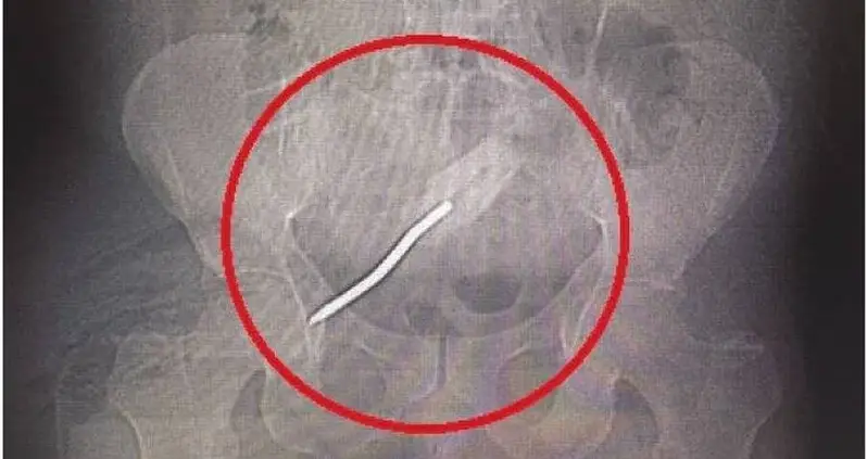 Florida Man Lodges Eight-Inch Screwdriver Inside His Rectum — And Loses Part Of His Buttocks In The Process