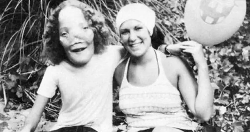 The Vibrant Life Of Rocky Dennis, The Boy Whose Rare Deformity Inspired The Film ‘Mask’