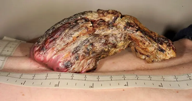 Doctors Remove 5-Inch-Long ‘Dragon Horn’ That Had Grown Out Of Man’s Back For 3 Years