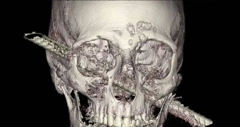 Construction Accident Leaves Man With Iron Rod Jammed Through His Head — And He Says He Felt No Pain