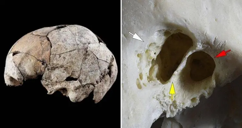 5,300-Year-Old Skull Unearthed In Spanish Tomb Shows Evidence Of Earliest Ear Surgery