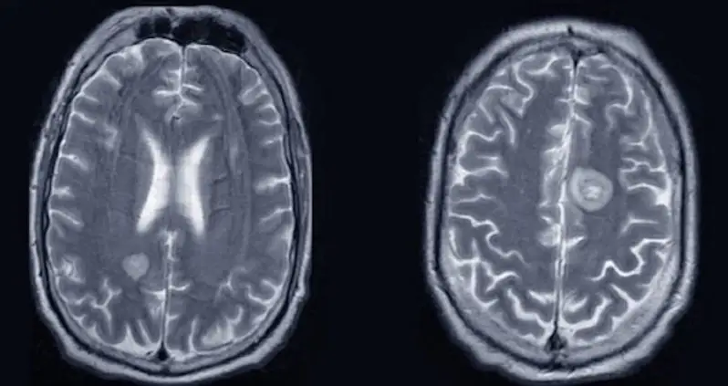 An American Man With Prostate Cancer Started Speaking In An Irish Accent In The Third Known Case Of Cancer-Related Foreign Accent Syndrome