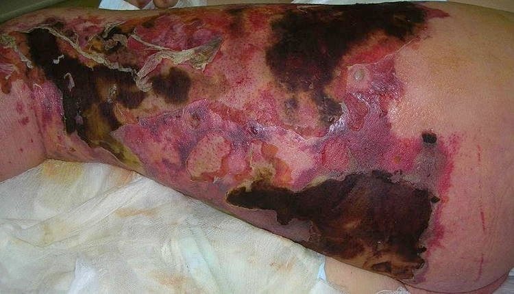 Weirdest Diseases Of The Human Body Flesh Eating Bacteria