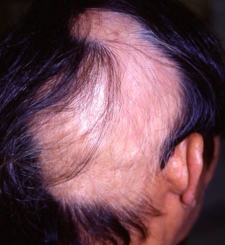 Weirdest Diseases Of The Human Body Trichotillomania