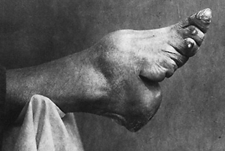 Foot Binding Photograph