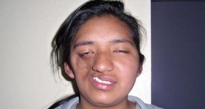 Interesting Diseases Parry Romberg Syndrome Og