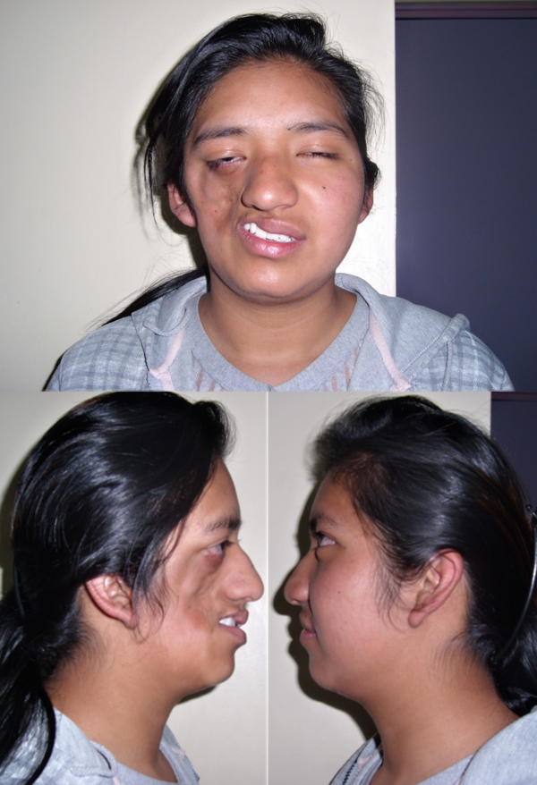 Interesting Diseases Parry Romberg Syndrome