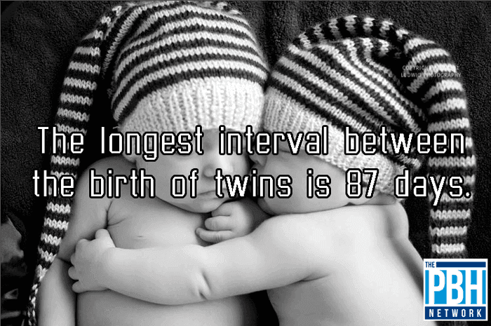 Twins Separation At Birth