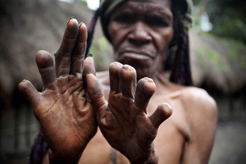 Interesting Articles Finger Cutting