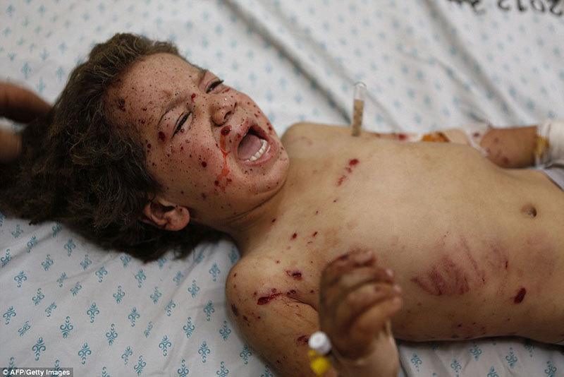 Child Injured from Israeli Airstrikes