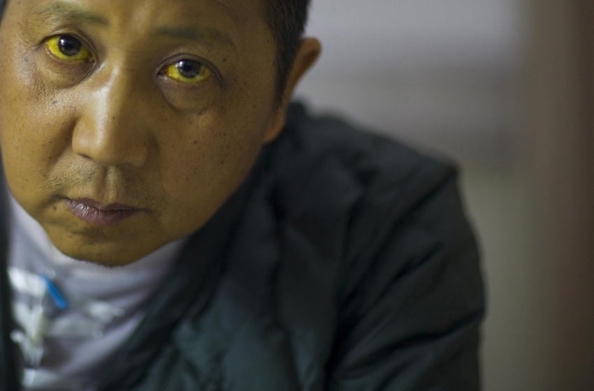 Chinese Cancer Villages Jaundice